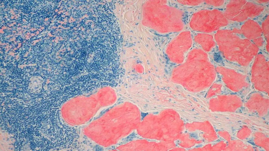 Amyloid deposits stain intensely with Congo red dye under standard light microscopy.
