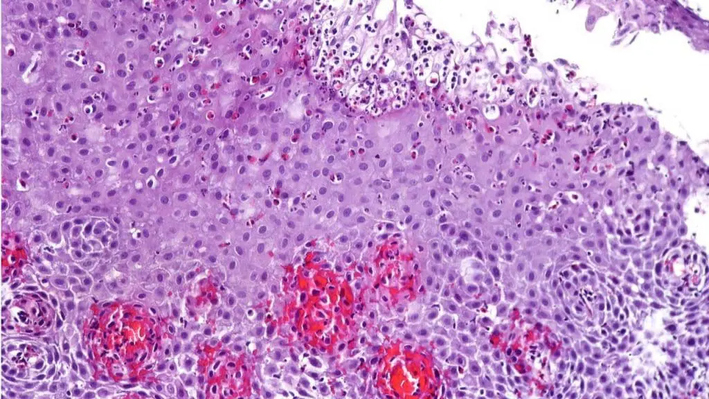 H&E stain showing eosinophilic esophagitis with key features of intraepithelial eosinophils.