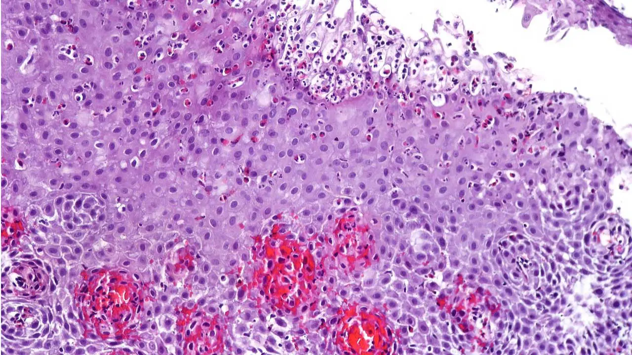 Eosinophilic Esophagitis (EoE)