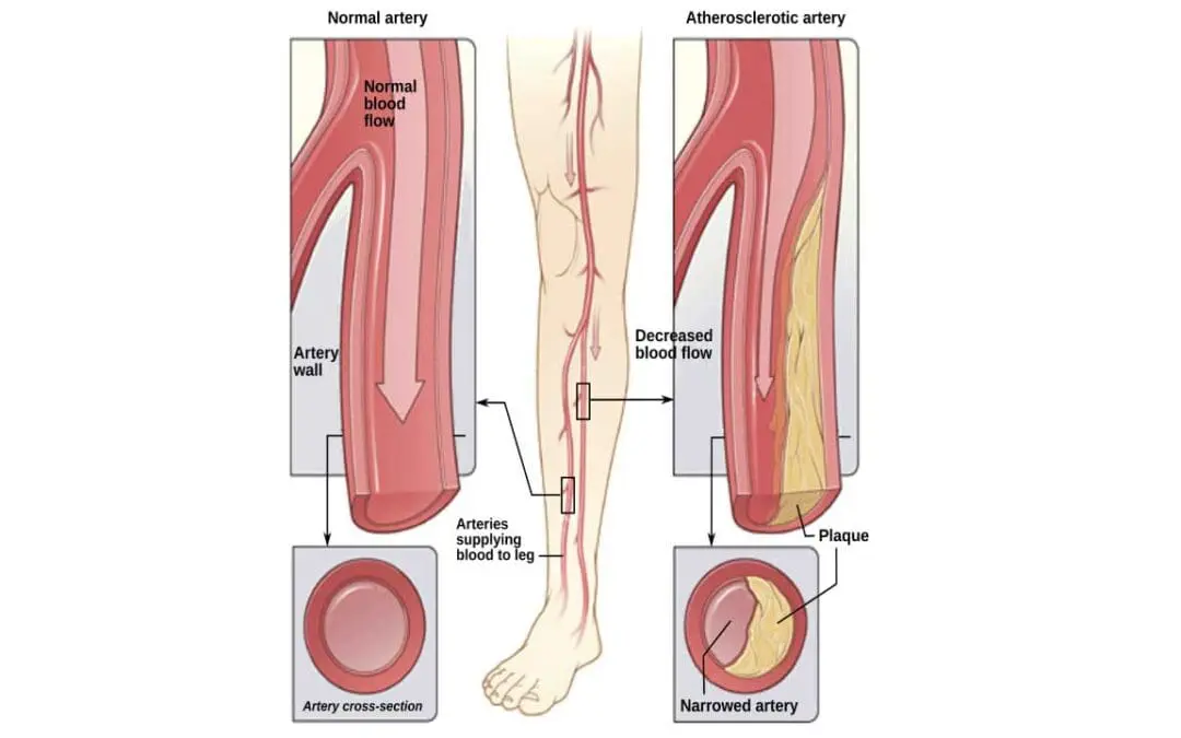 Peripheral Artery Disease (PAD)