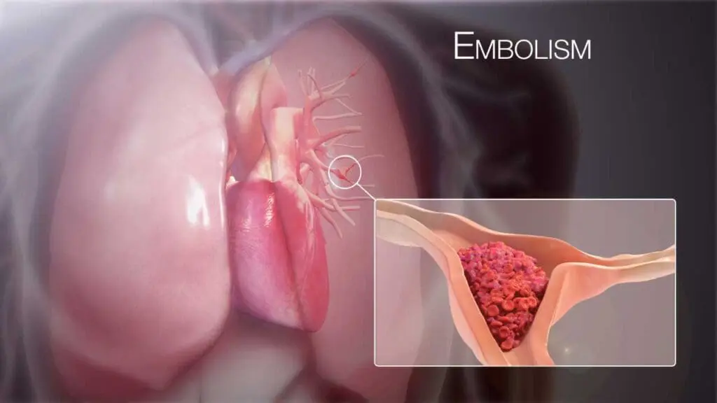 Pulmonary embolism (PE) is a potentially life-threatening condition caused by a blockage in one of the pulmonary arteries in the lungs, most often due to a blood clot that has traveled from the deep veins of the legs.