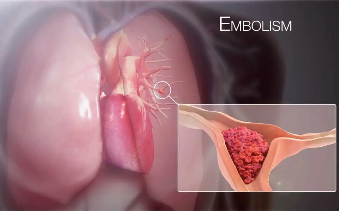 Pulmonary Embolism (PE)