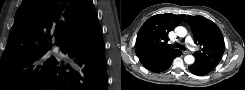 The CTPA showed a saddle embolus, indicating a major blockage, and extensive clots within the pulmonary arteries of both lungs.