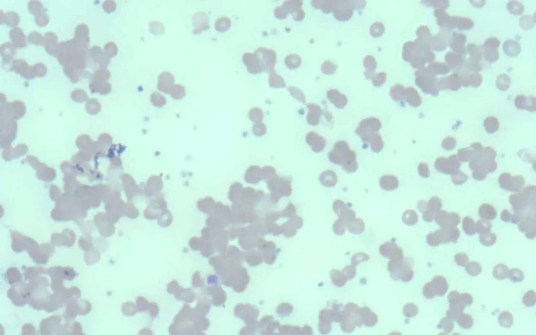 Cold Agglutinin Disease