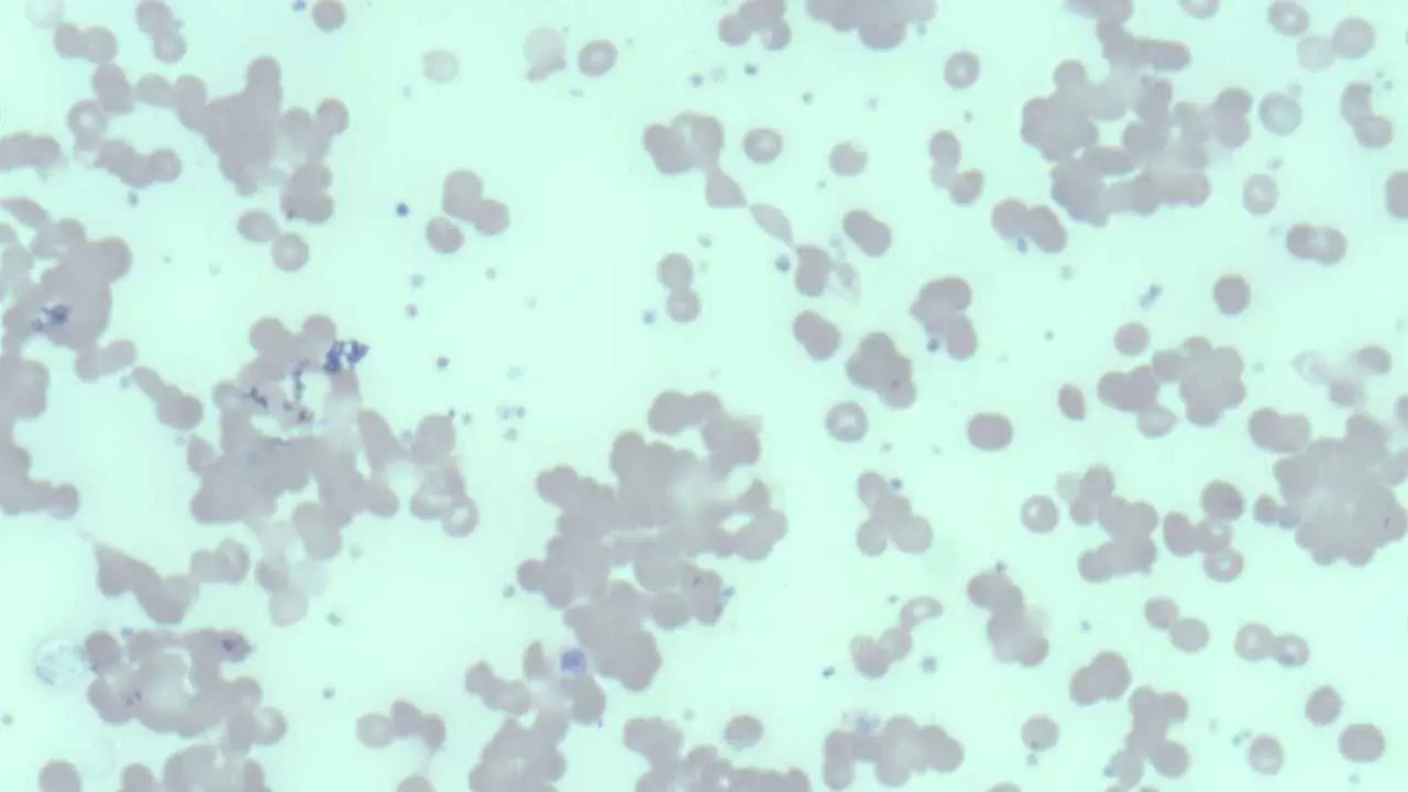 Cold Agglutinin Disease