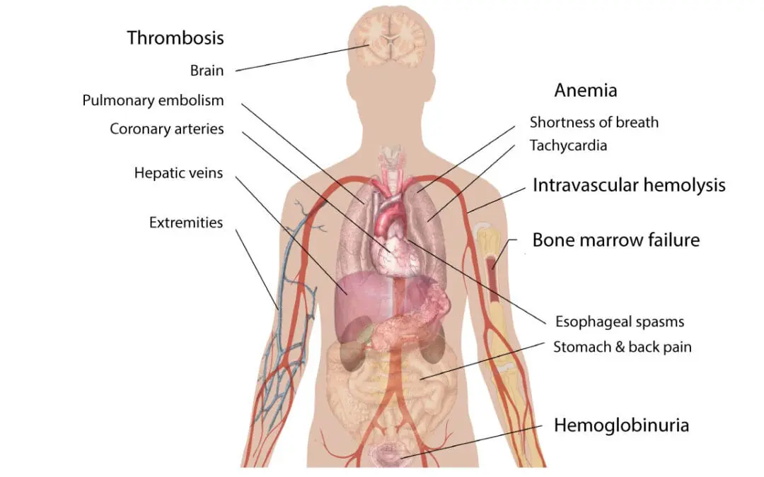 Paroxysmal Nocturnal Hemoglobinuria (PNH)
