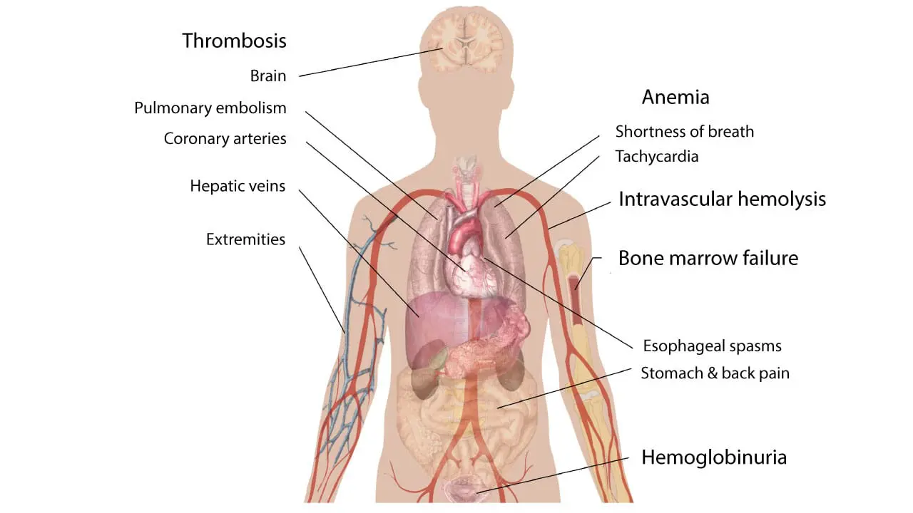 Paroxysmal Nocturnal Hemoglobinuria (PNH)