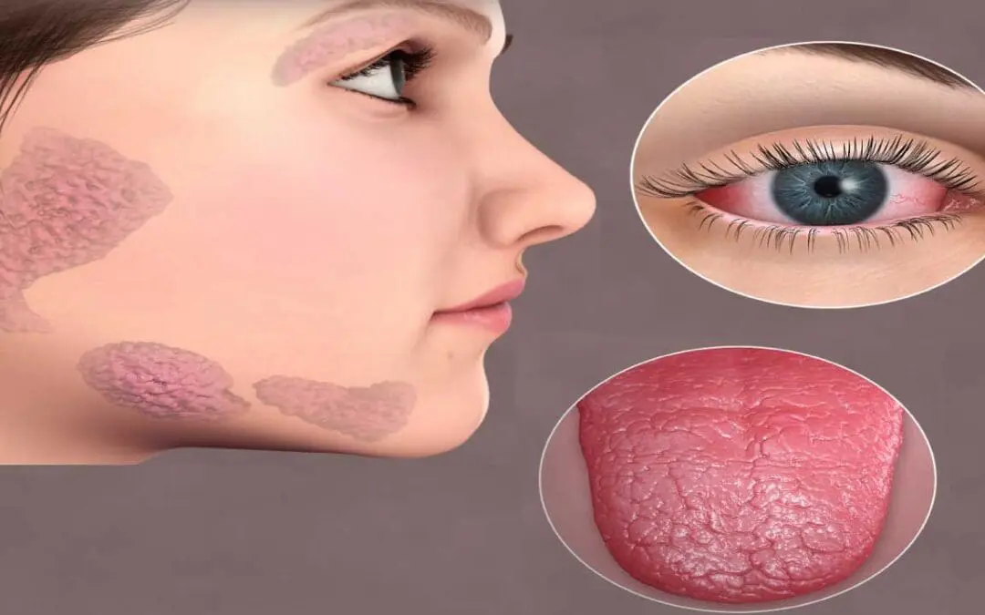 Sjögren’s Syndrome