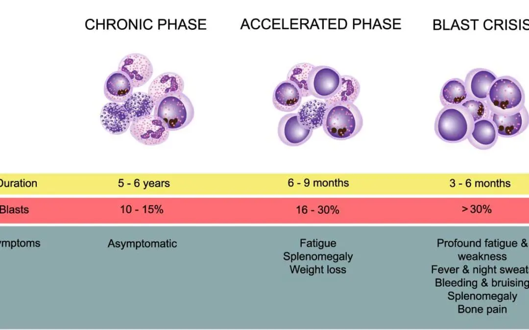 Chronic Myeloid Leukemia Treatment Strategies