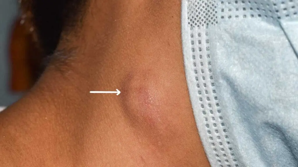 Lymphadenopathy is referred to as the enlargement of the lymph nodes. This can be caused by many factors including infections and malignancies. 