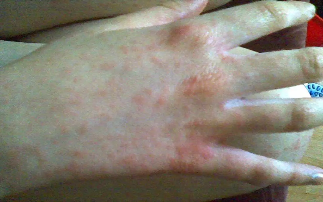 Infectious Mononucleosis (Mono)