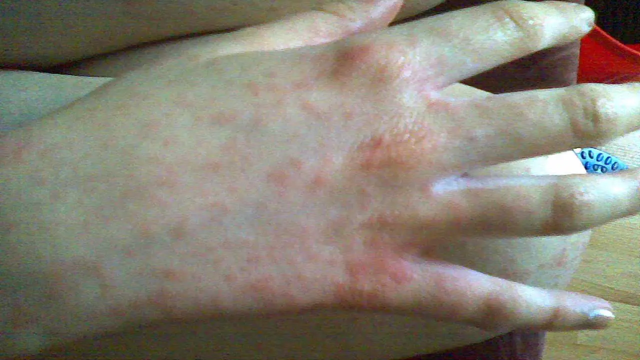 Infectious Mononucleosis (Mono)