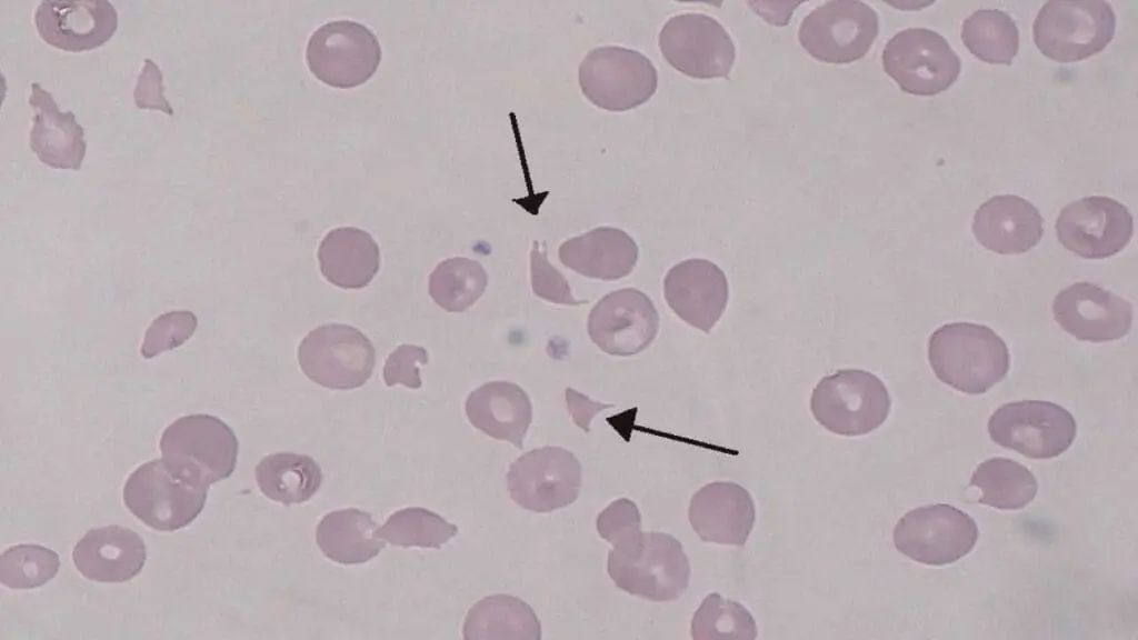 A photomicrograph of a peripheral blood smear with schistocytes (black arrow), polychromatic cells and spherocytes which are  hallmarks of microangiopathic hemolytic anemia as seen in hemolytic uremic syndrome (HUS). 