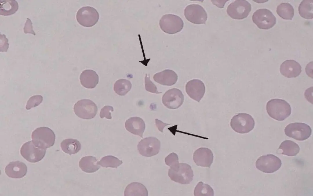Hemolytic Uremic Syndrome (HUS)