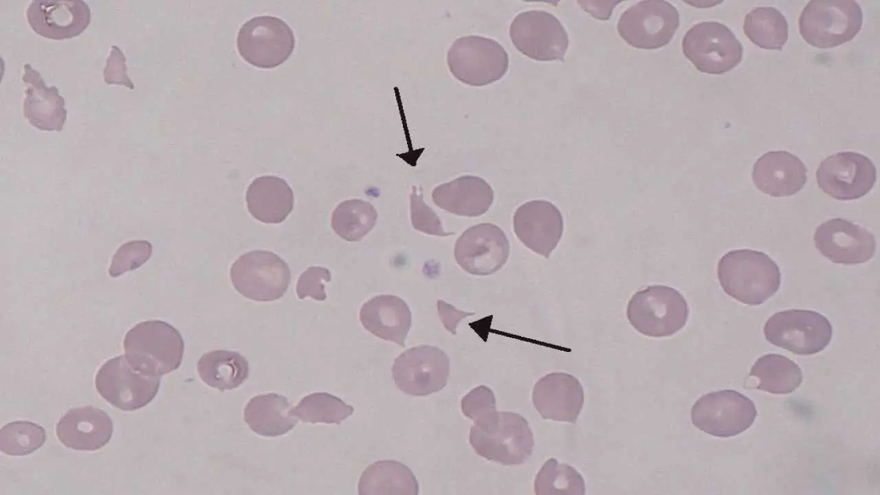 Hemolytic Uremic Syndrome (HUS)