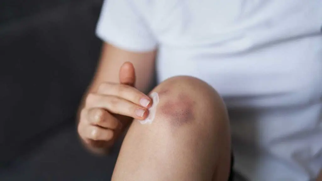 The primary sign of ecchymoses is the visible discoloration of the skin.