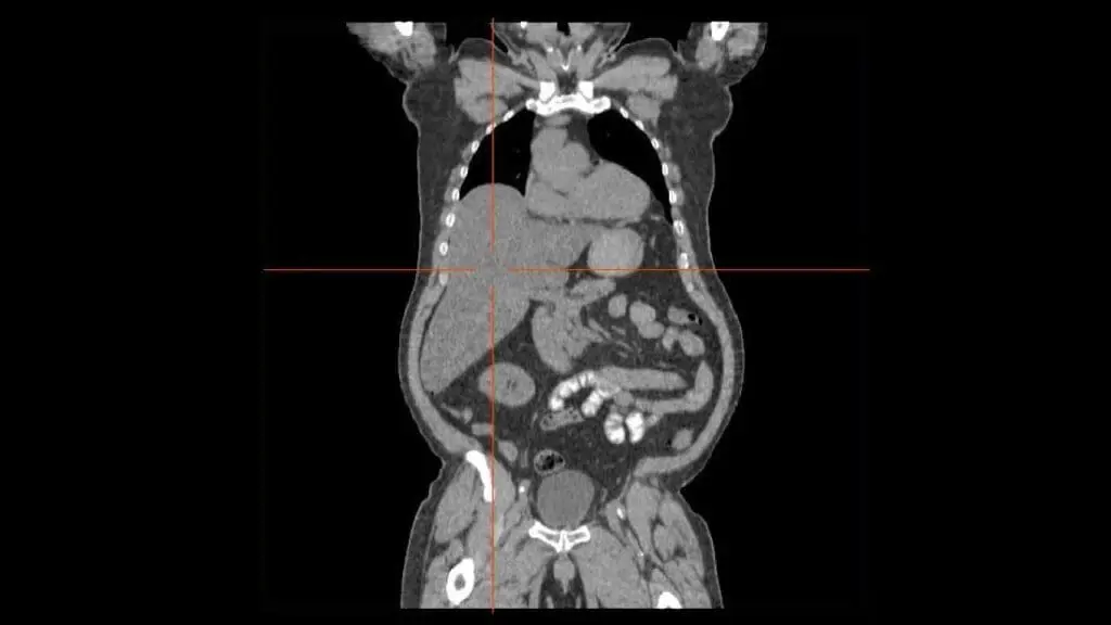 A CT scan image showing severe hepatomegaly extending down to the left side of the abdomen. 