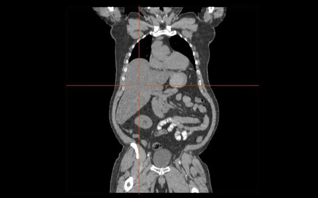 Liver and Causes of Hepatomegaly