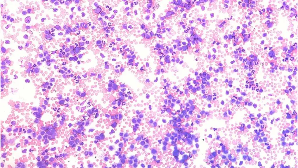 Persistent monocytosis (high monocytes) is seen in the peripheral blood smear of chronic myelomonocytic leukemia.