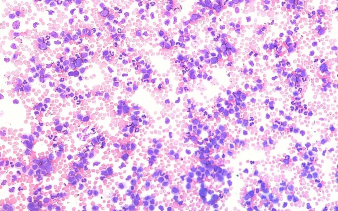 Monocytosis (High Monocytes)