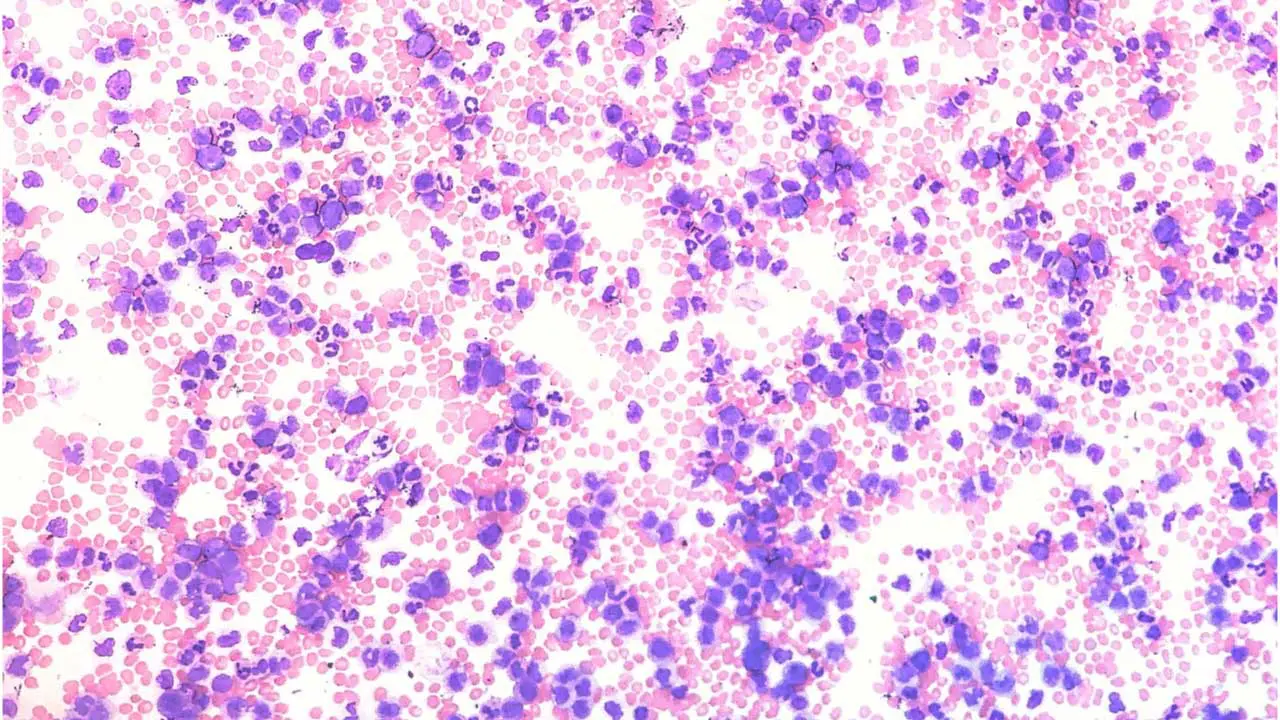 Monocytosis (High Monocytes)