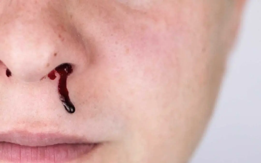 Bernard-Soulier Syndrome