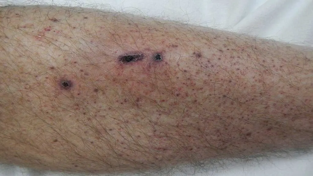Appearance of petechiae in the lower limb due to immune thrombocytopenia.
