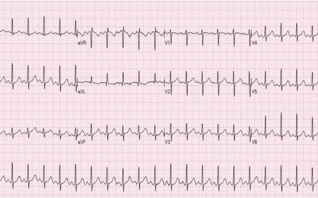 Tachycardia in Hematological Patients