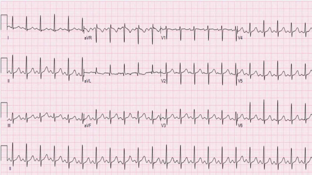 Tachycardia in Hematological Patients