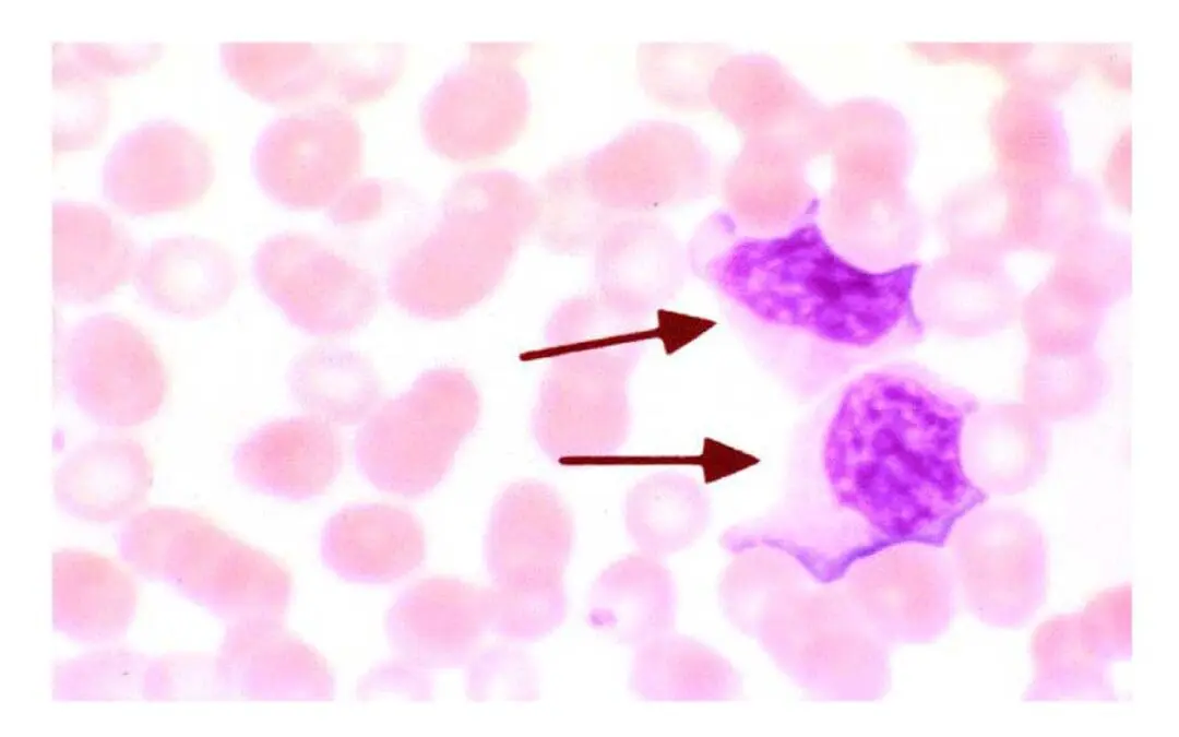 Causes of Atypical Lymphocytes (Reactive Lymphocytes)