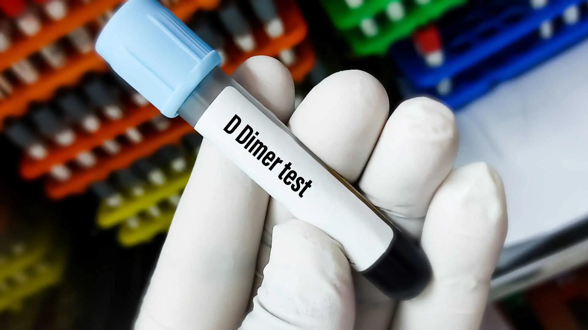 D-Dimer Test
