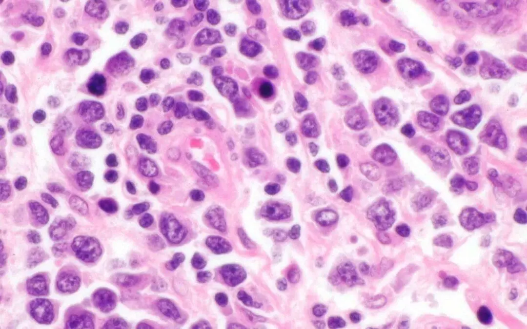 Diffuse Large B-Cell Lymphoma (DLBCL)