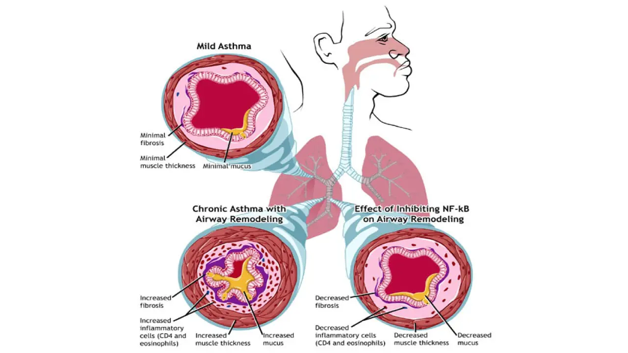 Eosinophilic Asthma