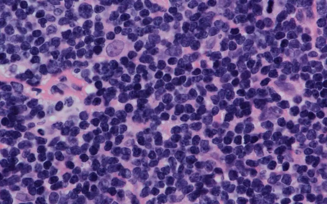 Mantle Cell Lymphoma (MCL Disease)