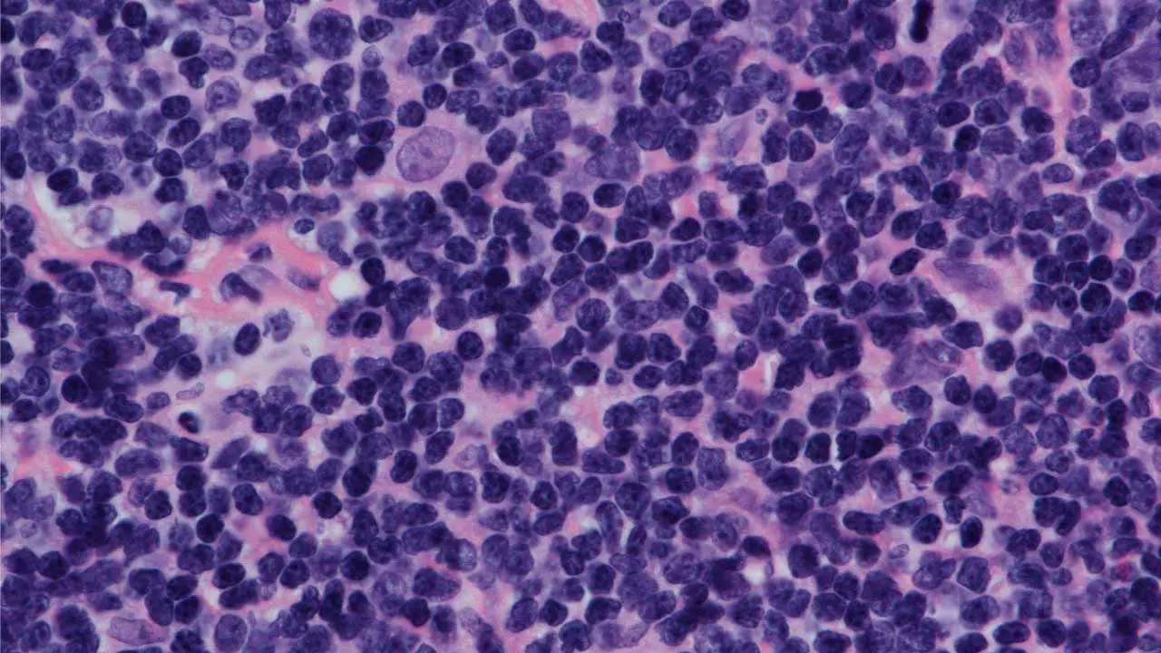 Mantle Cell Lymphoma (MCL Disease)