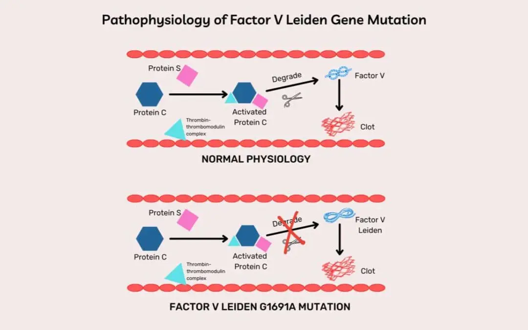 Factor V Leiden Thrombophilia