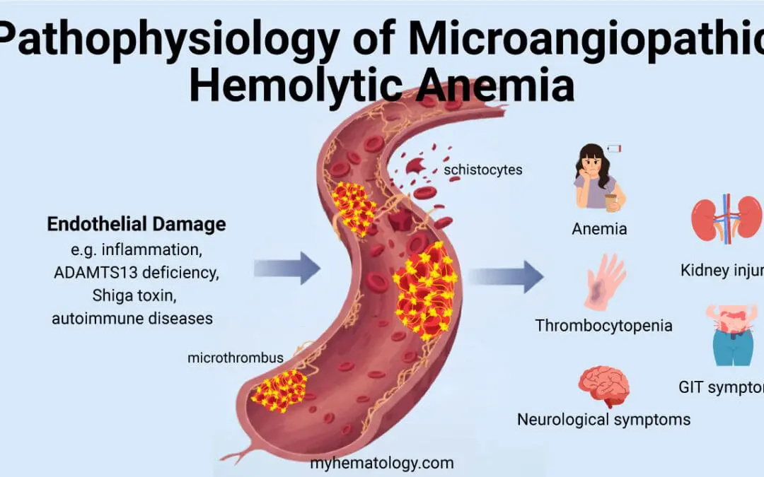 Microangiopathic Hemolytic Anemia (MAHA)