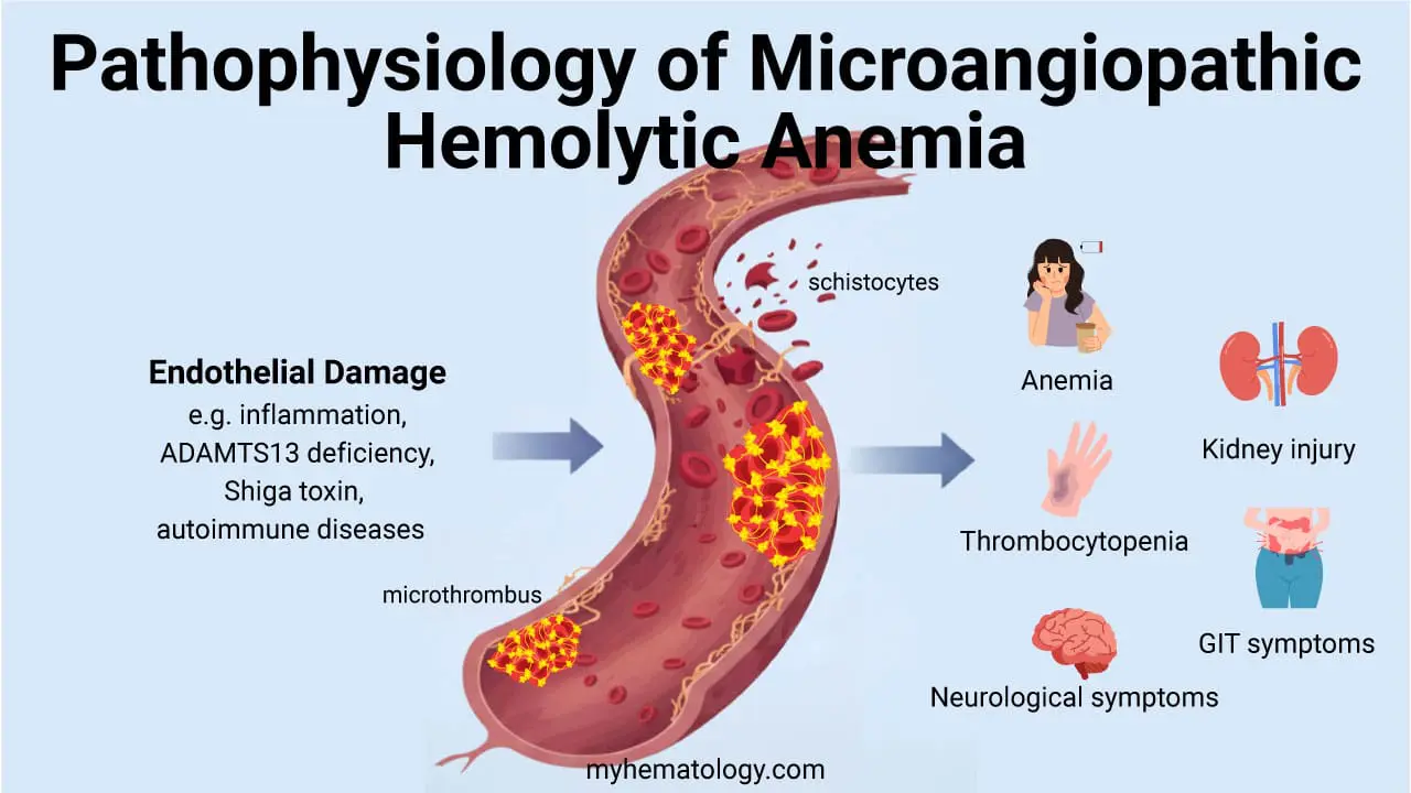 Microangiopathic Hemolytic Anemia (MAHA)