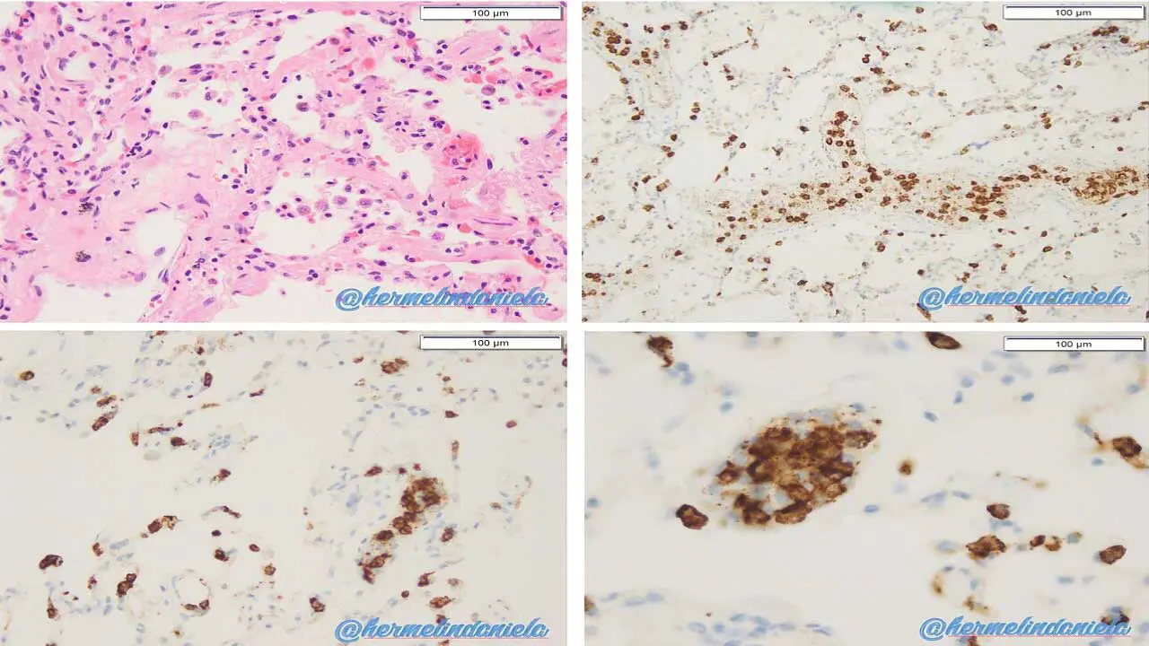 Transfusion-Related Acute Lung Injury or TRALI
