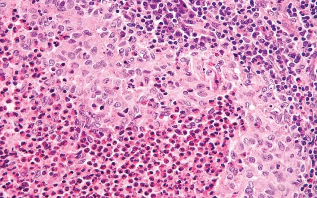 Langerhans Cell Histiocytosis (Histiocytosis X)