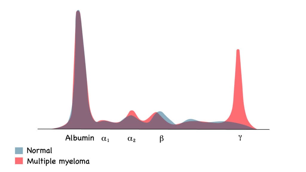 Serum protein electrophoresis showing the abnormal M protein spike in the gamma region in multiple myeloma