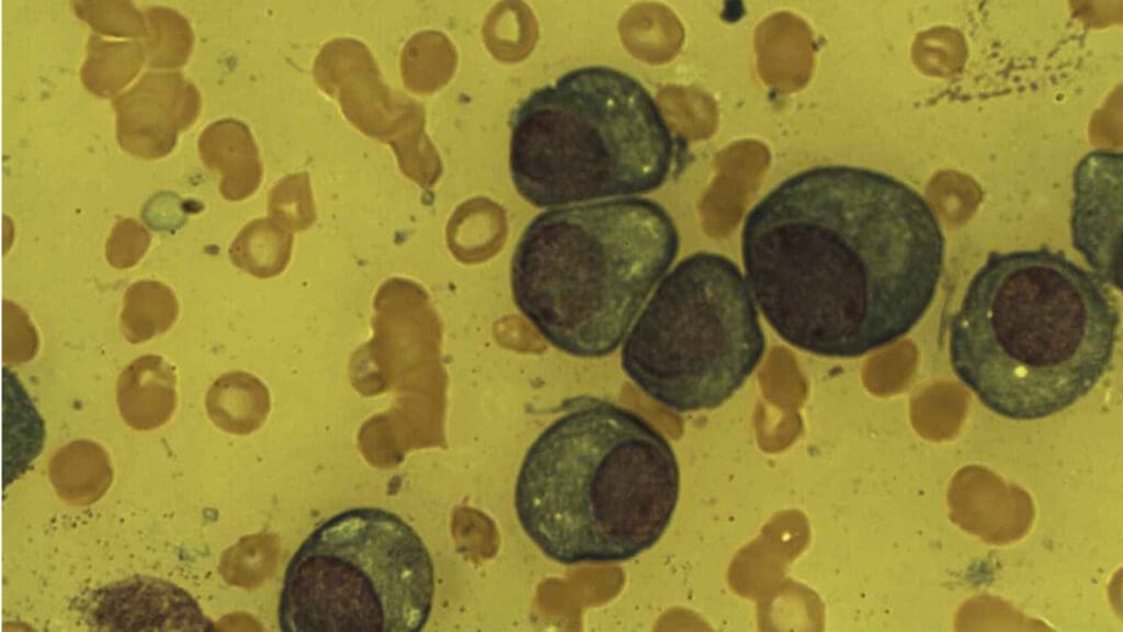 Presence of plasma cells in the bone marrow smear.