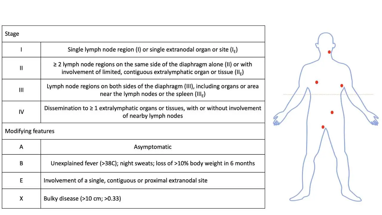 Image depicting the Ann Arbor staging system for diffuse large B-cell lymphoma (DLBCL), highlighting the different stages and their corresponding involvement of lymph nodes and extranodal organs