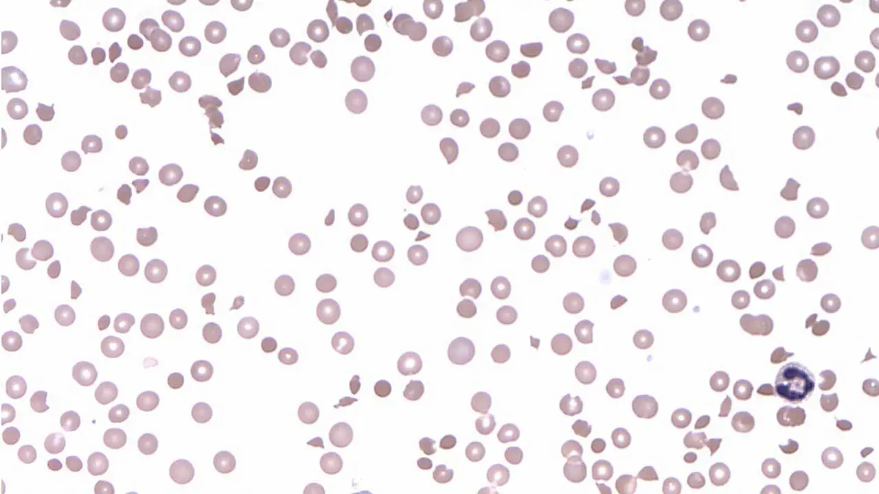 Thrombocytopenia: Causes, Symptoms, Investigations & Management