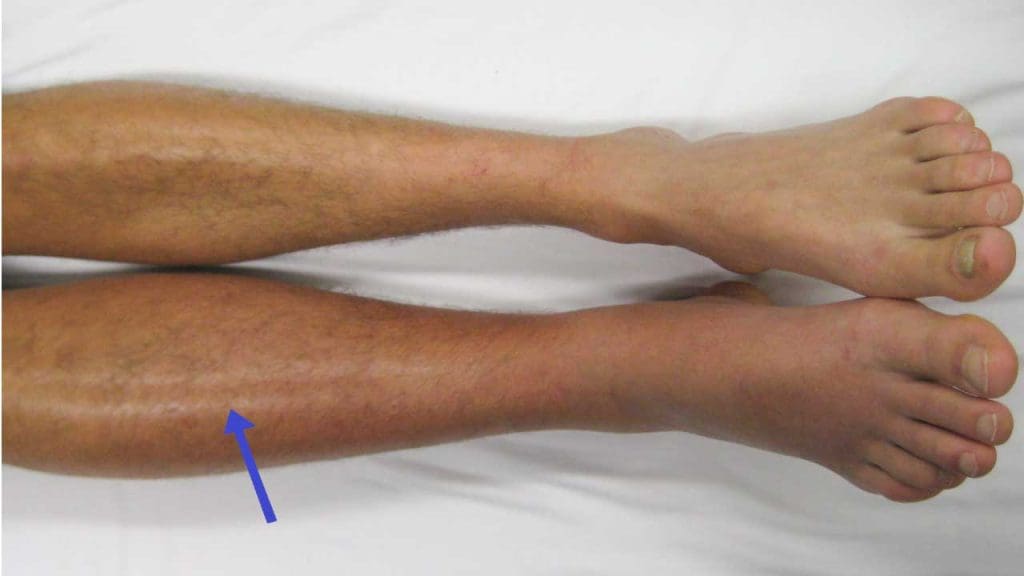 Deep vein thrombosis of the right leg. 