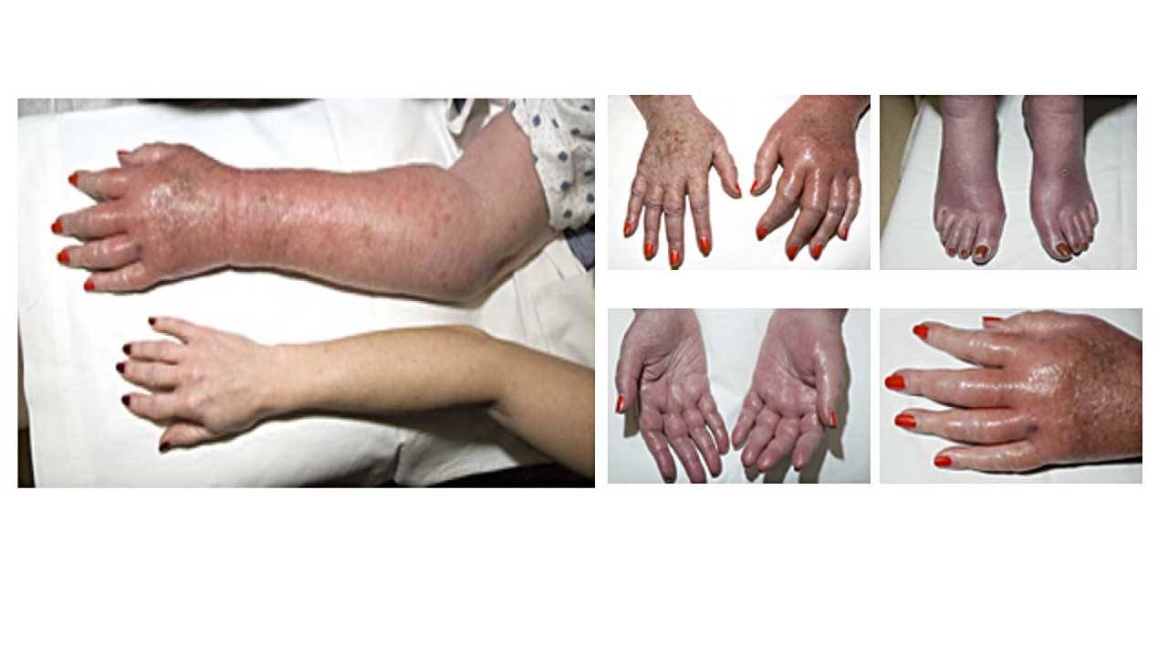 Polycythemia Vera Pv Causes Symptoms And Diagnosis