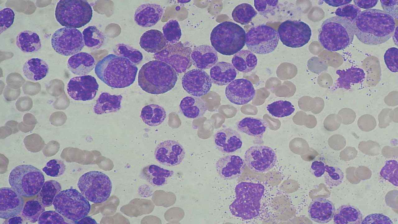 Leukocytosis: Types, Causes, Symptoms, Complications & Treatment