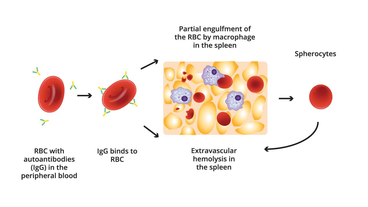 Autoimmune Hemolytic Anemia (AIHA): Warm AIHA & CAD