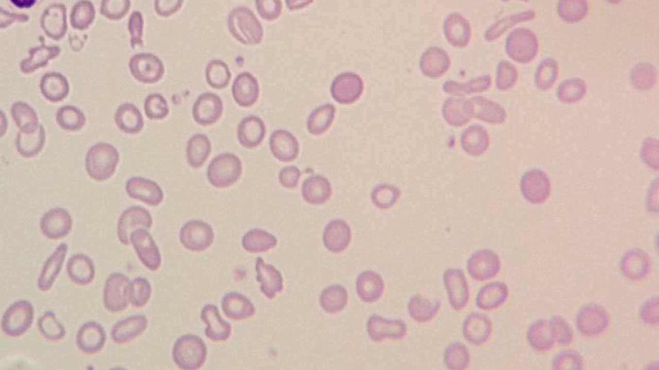 Hypochromic Anemia: Types, Symptoms & Differential Diagnosis