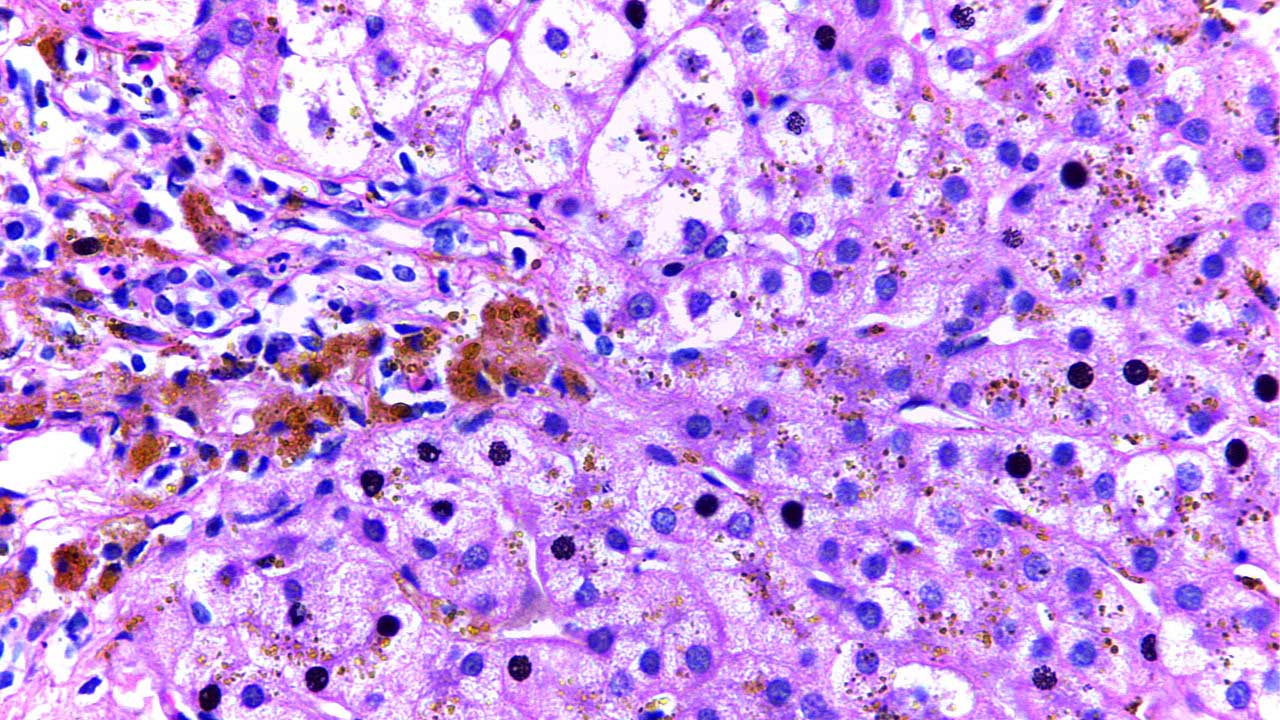 Hereditary Hemochromatosis | My Hematology